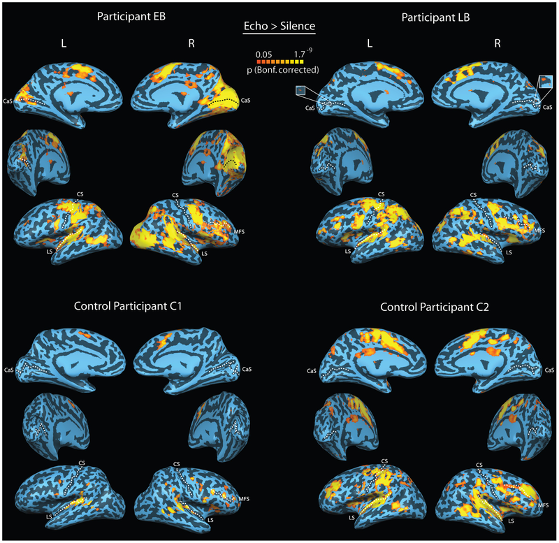 Illustration for article titled Mapping the Brains of Human Echolocators